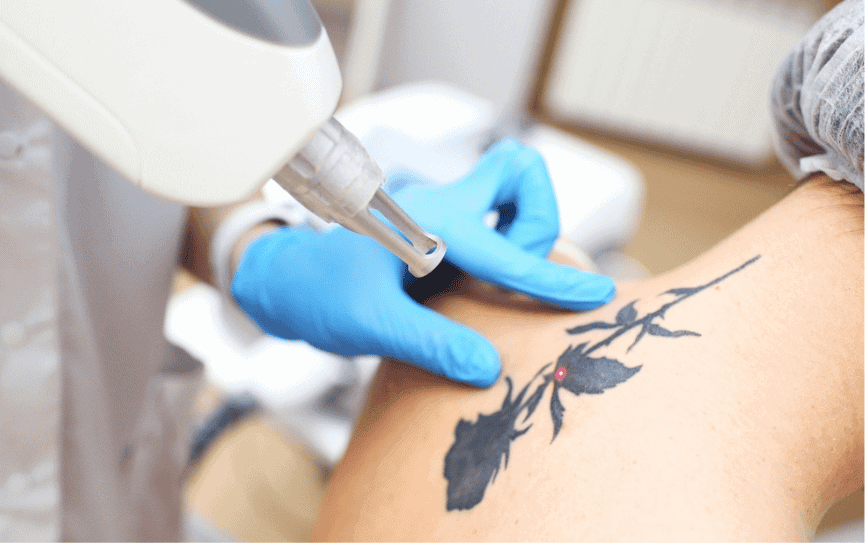 tatto remover